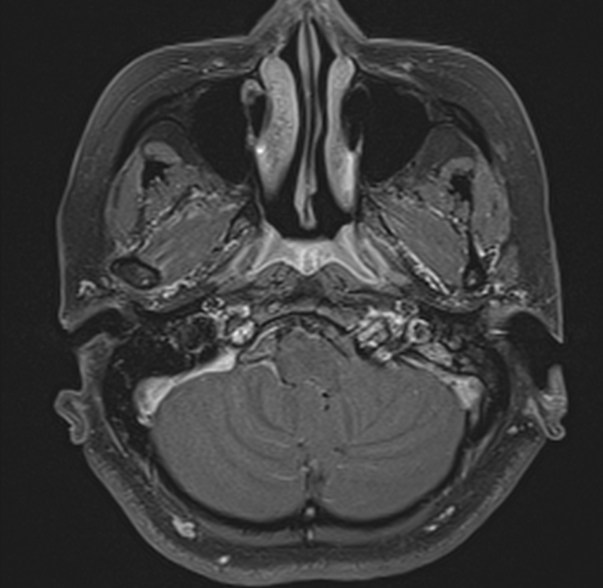 File:Cerebellopontine angle meningioma (Radiopaedia 53561-59591 Axial T1 C+ fat sat 6).jpg