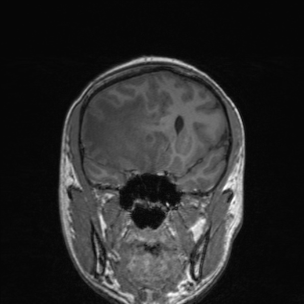 Cerebral abscess (Radiopaedia 24212-24478 Coronal T1 83).jpg