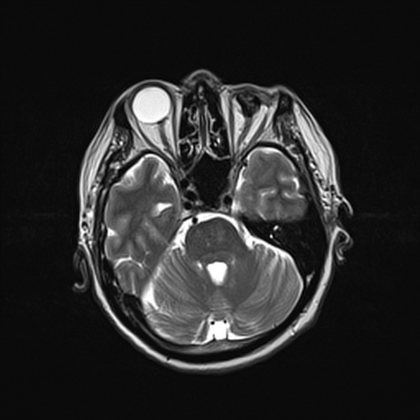 Cerebral abscess (Radiopaedia 26111-26247 Axial T2 22).jpg