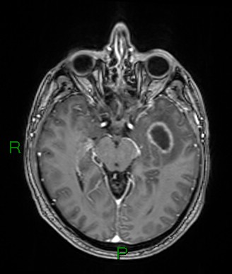 File:Cerebral abscess and subdural empyema (Radiopaedia 84436-99779 Axial T1 C+ 51).jpg