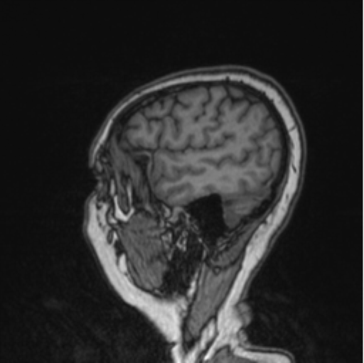 File:Cerebral abscess from pulmonary arteriovenous malformation (Radiopaedia 86275-102291 Sagittal T1 29).png