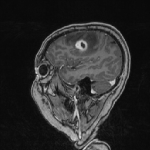 Cerebral abscess from pulmonary arteriovenous malformation (Radiopaedia 86275-102291 Sagittal T1 C+ 60).png