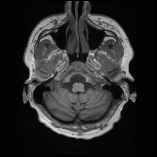 File:Cerebral abscess with ventriculitis (Radiopaedia 78965-91878 Axial T1 7).jpg