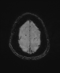 Cerebral amyloid angiopathy-related inflammation (Radiopaedia 74836-85849 Axial SWI 64).jpg