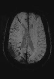 File:Cerebral amyloid angiopathy (Radiopaedia 29129-29518 Axial SWI MIP 21).jpg