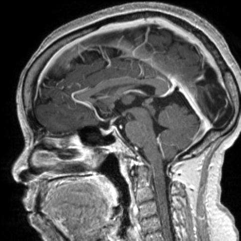 Cerebral amyloid angiopathy (Radiopaedia 29129-29518 Axial T1 C+ 157).jpg