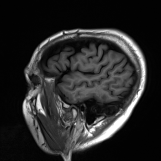 File:Cerebral amyloid angiopathy (Radiopaedia 46082-50433 Sagittal T1 24).png