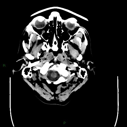 Cerebral amyloid angiopathy (Radiopaedia 77506-89665 Axial non-contrast 6).jpg