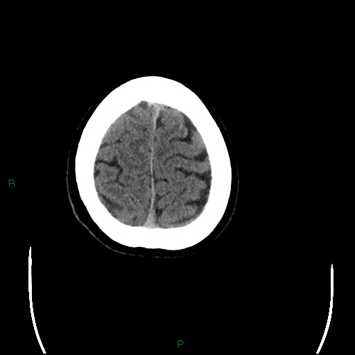 Cerebral amyloid angiopathy (Radiopaedia 77506-89665 Axial non-contrast 98).jpg