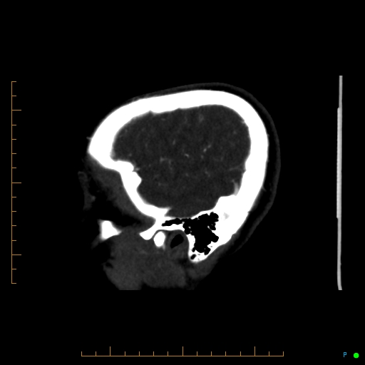 Cerebral arteriovenous malformation (AVM) (Radiopaedia 78162-90706 Sagittal CTA 68).jpg