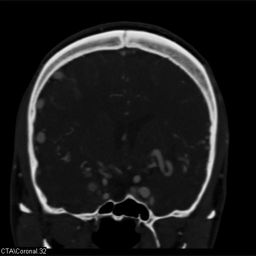 Cerebral arteriovenous malformation (Radiopaedia 28518-28759 C 32).jpg