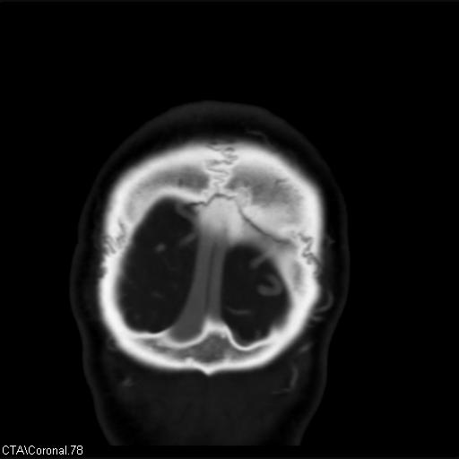 File:Cerebral arteriovenous malformation (Radiopaedia 28518-28759 C 78).jpg