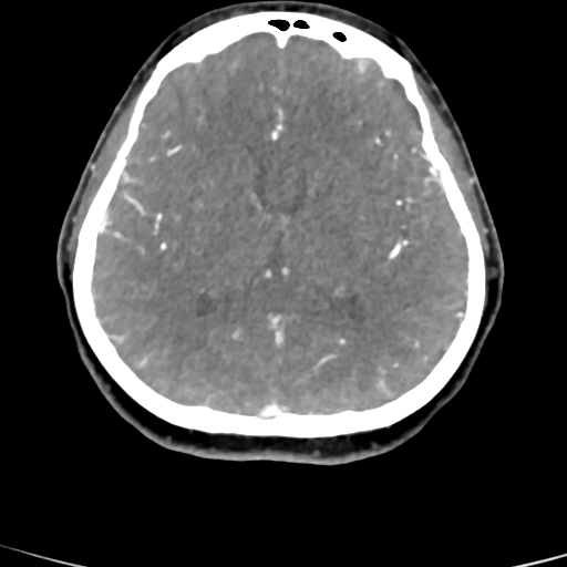File:Cerebral arteriovenous malformation (Radiopaedia 73830-84645 B 48).jpg