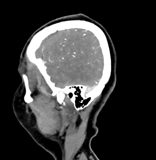 Cerebral arteriovenous malformation (Radiopaedia 73830-84645 D 79).jpg