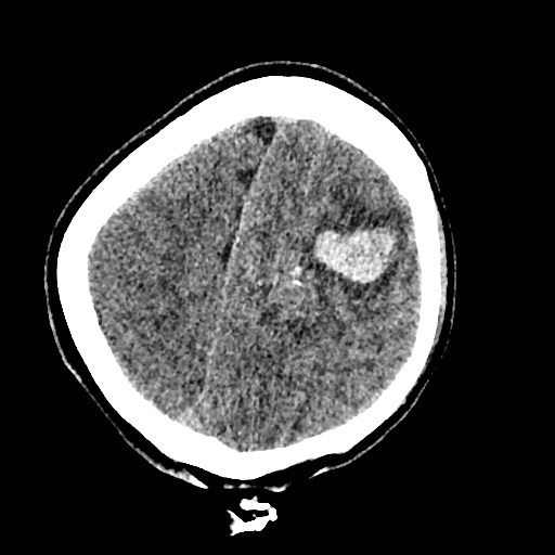 File:Cerebral arteriovenous malformation (Radiopaedia 79677-92887 Axial non-contrast 37).jpg