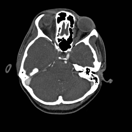 File:Cerebral arteriovenous malformation (Radiopaedia 79677-92888 A 11).jpg