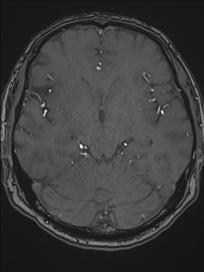 File:Cerebral arteriovenous malformation (Radiopaedia 84015-99245 Axial TOF 111).jpg