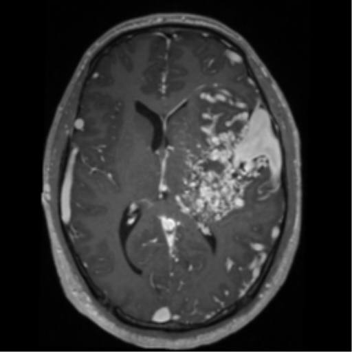 Cerebral arteriovenous malformation - huge (Radiopaedia 35734-37272 Axial T1 C+ 38).png