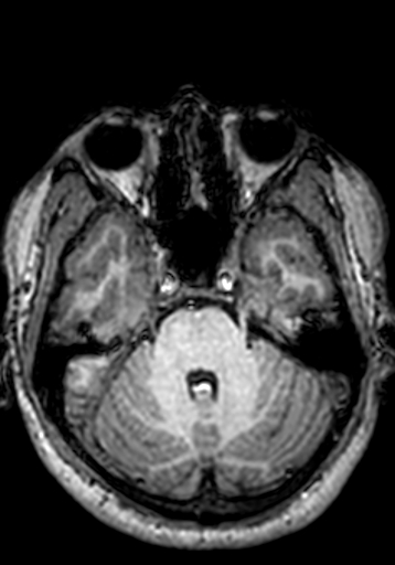 Cerebral arteriovenous malformation at posterior body of corpus callosum (Radiopaedia 74111-84925 Axial T1 225).jpg