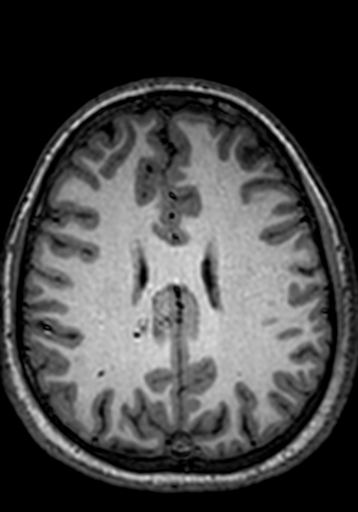 Cerebral arteriovenous malformation at posterior body of corpus callosum (Radiopaedia 74111-84925 Axial T1 96).jpg