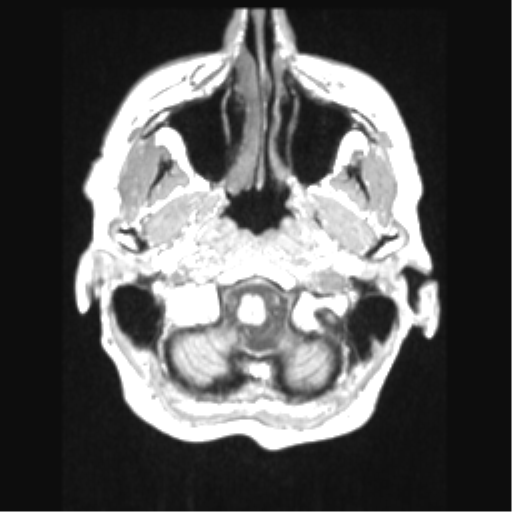 File:Cerebral arteriovenous malformation with hemorrhage (Radiopaedia 34422-35737 Axial T1 9).png