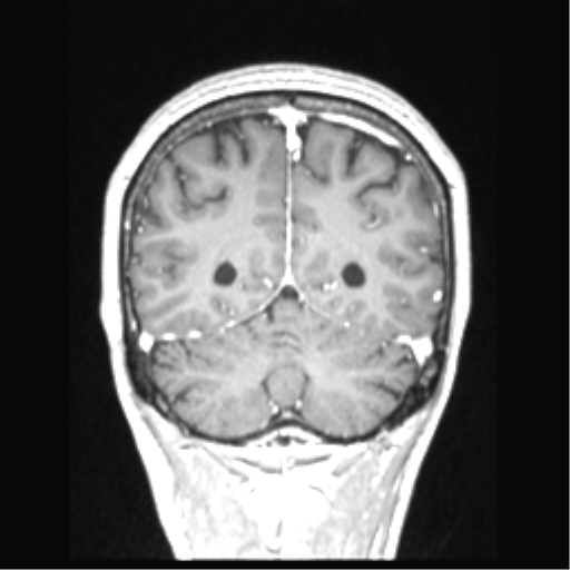 Cerebral arteriovenous malformation with hemorrhage (Radiopaedia 34422-35737 Coronal T1 C+ 25).png