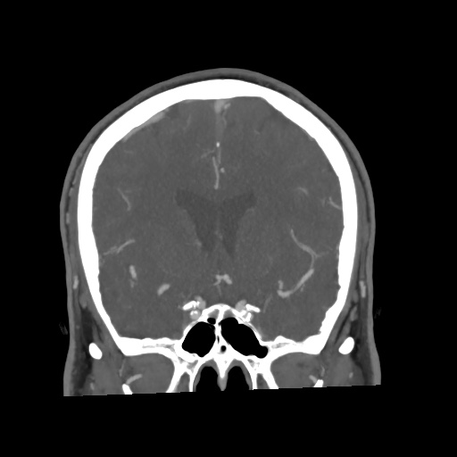 Cerebral arteriovenous malformation with lobar hemorrhage (Radiopaedia 35598-57216 C 39).jpg