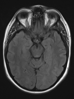 File:Cerebral cavernoma and development venous anomaly (Radiopaedia 37603-39482 Axial FLAIR 9).png
