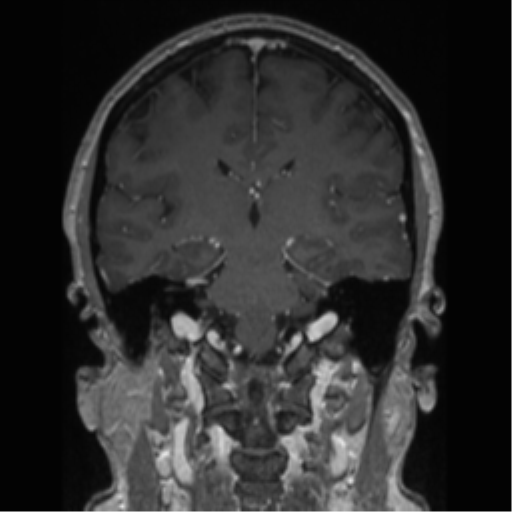 Cerebral cavernoma and development venous anomaly (Radiopaedia 37603-39482 Coronal T1 C+ 44).png