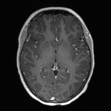 Cerebral cavernous venous malformation (Radiopaedia 70008-80021 Axial T1 C+ 35).jpg