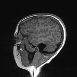 File:Cerebral cavernous venous malformation (Radiopaedia 70008-80021 Sagittal T1 60).jpg