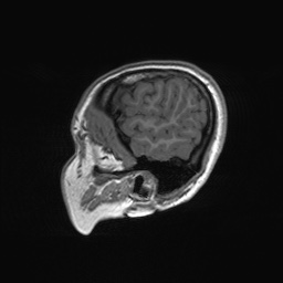 File:Cerebral cavernous venous malformation (Radiopaedia 70008-80021 Sagittal T1 67).jpg