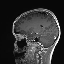 Cerebral cavernous venous malformation (Radiopaedia 70008-80021 Sagittal T1 C+ 46).jpg