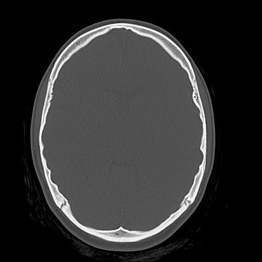Cerebral cavernous venous malformation (Radiopaedia 70008-80022 Axial bone window 23).jpg
