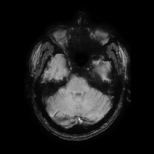 File:Cerebral cavernous venous malformation (Zabramski type II) (Radiopaedia 85511-101198 Axial SWI 43).jpg