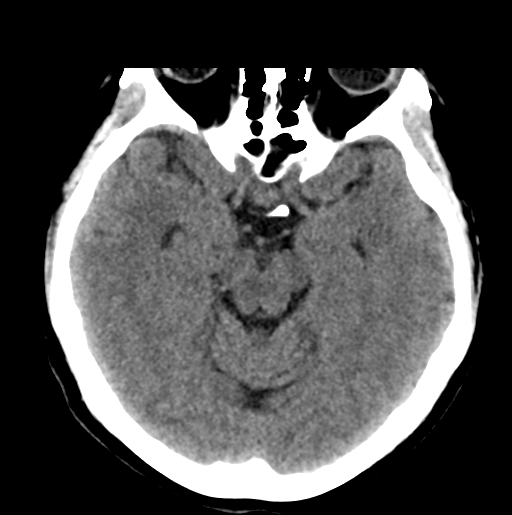 File:Cerebral cavernous venous malformations (Radiopaedia 48117-52945 Axial non-contrast 13).png