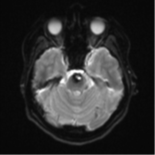 Cerebral cavernous venous malformations (Radiopaedia 48117-52946 Axial DWI 8).png