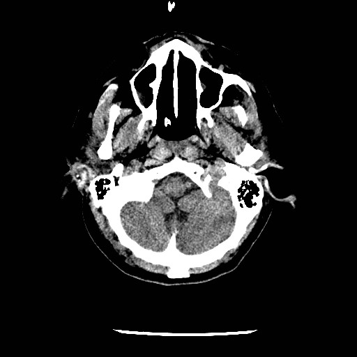 File:Cerebral edema (evolution in time) (Radiopaedia 19418-19441 non-contrast 12).jpg