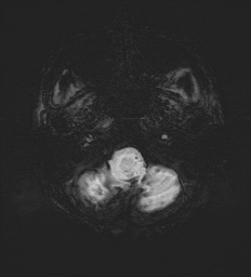 Cerebral embolic infarcts (embolic shower) (Radiopaedia 72391-82921 Axial SWI 7).jpg