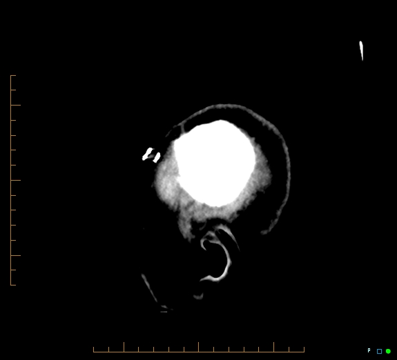 Cerebral fat embolism (Radiopaedia 85521-101220 B 3).jpg