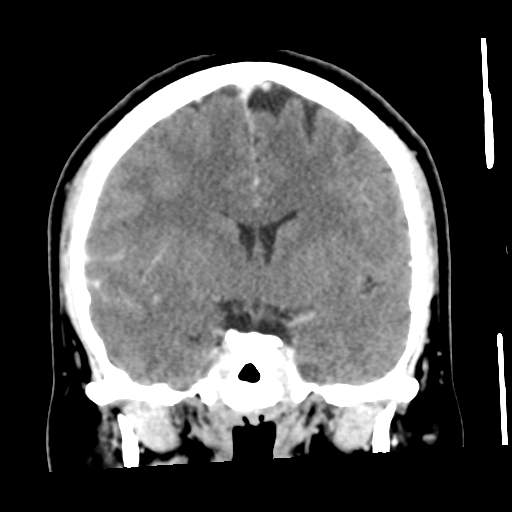 File:Cerebral hemorrhage secondary to arteriovenous malformation (Radiopaedia 33497-34561 C 30).png