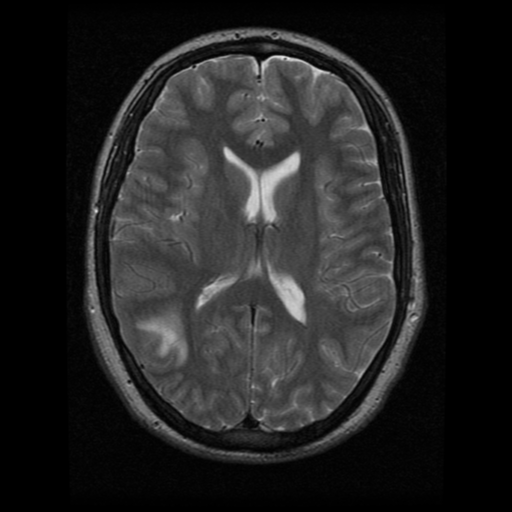 File:Cerebral hemorrhage secondary to arteriovenous malformation (Radiopaedia 33497-34572 Axial T2 14).png