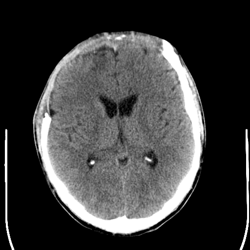 File:Cerebral hemorrhagic contusions- temporal evolution (Radiopaedia 40224-42756 Axial non-contrast 14).png