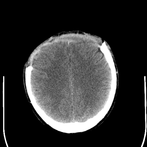 File:Cerebral hemorrhagic contusions- temporal evolution (Radiopaedia 40224-42756 Axial non-contrast 19).png