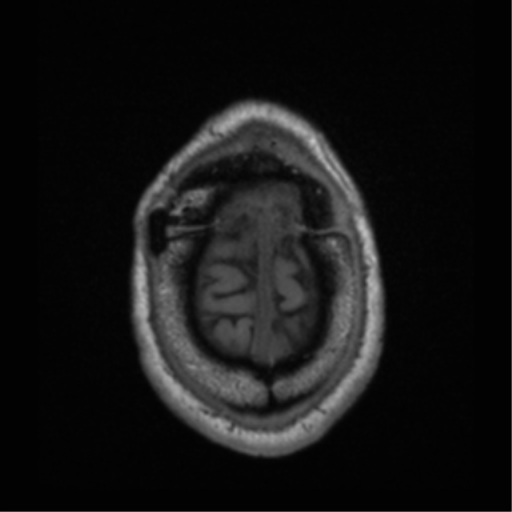 Cerebral hemorrhagic contusions- temporal evolution (Radiopaedia 40224-42757 Axial T1 72).png