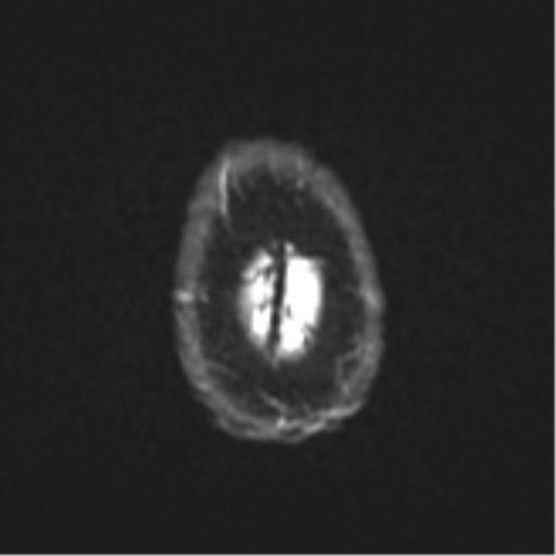 Cerebral metastasis - colorectal adenocarcinoma (Radiopaedia 50394-55765 Axial DWI 27).png