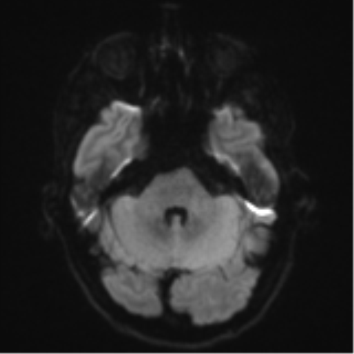 Cerebral metastasis - melanoma (Radiopaedia 54718-60954 Axial DWI 39).png