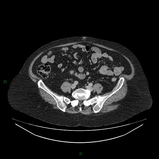 Cerebral metastasis from renal cell carcinoma (Radiopaedia 82306-96378 A 126).jpg