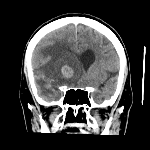 Cerebral metastasis to basal ganglia (Radiopaedia 81568-95412 Coronal C+ delayed 24).png