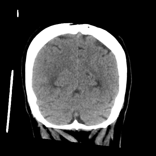 Cerebral metastasis to basal ganglia (Radiopaedia 81568-95412 Coronal non-contrast 53).png